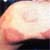 Do People Still Get Leprosy?